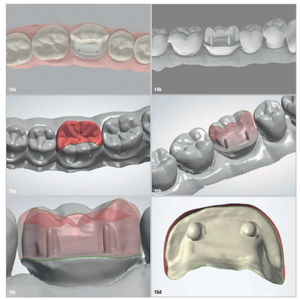 From Traditional Dentistry to Digital Innovation: A Modern Zirconia Pinlay Workflow